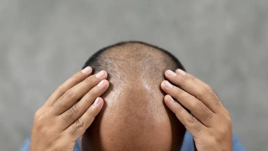 Efek Samping Bahaya Minoxidil Untuk Menumbuhkan Brewok - Rambut Botak Ini Dia Penyebab Dan Cara Mengatasinya -