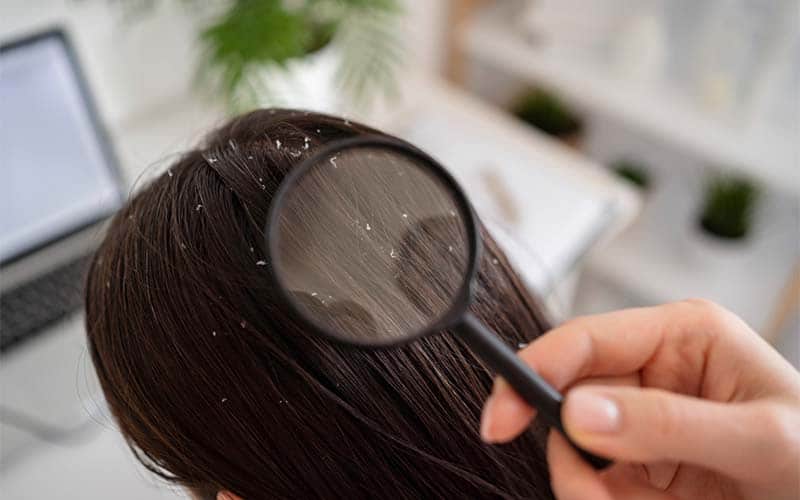 Cara Mengatasi Rambut Berketombe