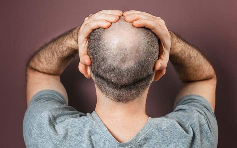 9 Cara Menumbuhkan Rambut Botak Dengan Cepat Dan Aman