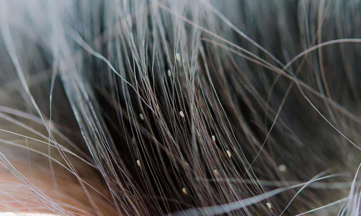 Cara Menghilangkan Kutu Rambut dengan Garam yang Ampuh