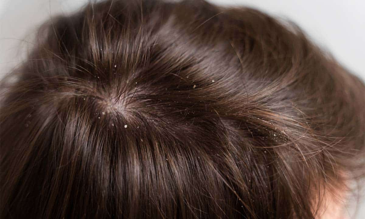 Hair Spa Untuk Menghilangkan Ketombe